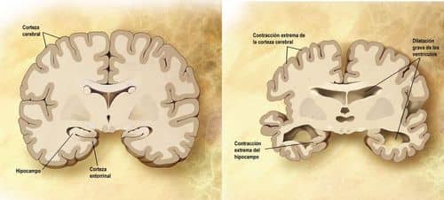 Estados Unidos aprueba el segundo medicamento contra el Alzheimer: Donanemab