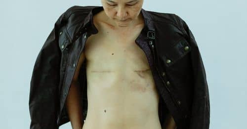 Serious Asian woman with scars after breast removal