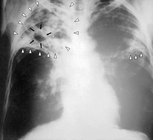 Tuberculosis en Córdoba: Preocupación por el aumento de casos