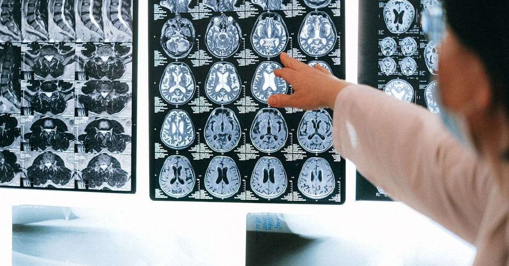 Alerta: Las carnes procesadas pueden dañar tu cerebro y memoria