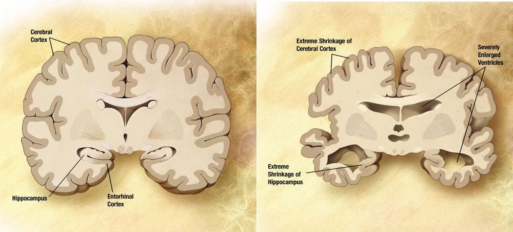 Enfermedad de Alzheimer