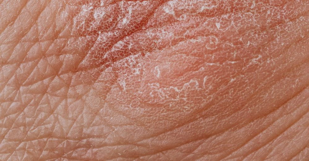 Close-up View Of Human Dry Skin